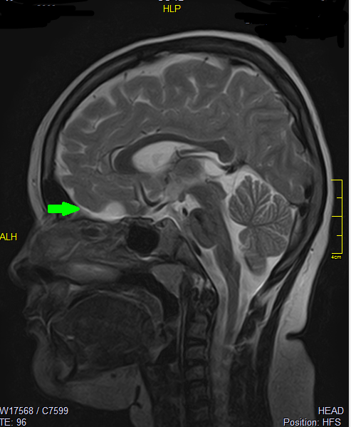 удаление арахноидальной кисты медио-базальных отделов лобных долей головного мозга в НПЦ медпомощи детям им. Войно-Ясенецкого